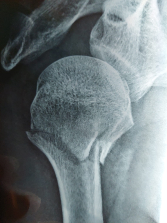 治療前 - 手腕腫脹情況